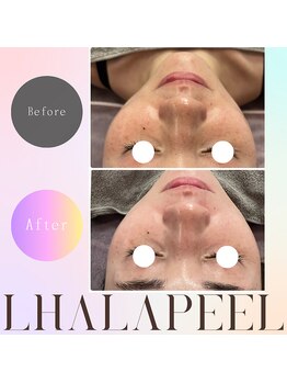 バブルビューティー(Bubble beauty)/ララピール・LDM・LED1回施術後