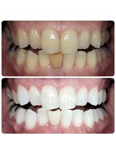 ホワイトニングセンター 広島福山駅前店/福山市・尾道市ホワイトニング