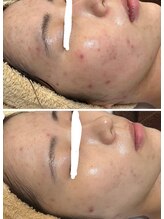 ジェニー(JENNI)/LDMコース　施術３回