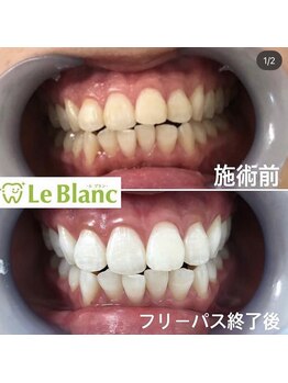 ルブラン 奈良店(Le Blanc)/3週間で白い歯を♪