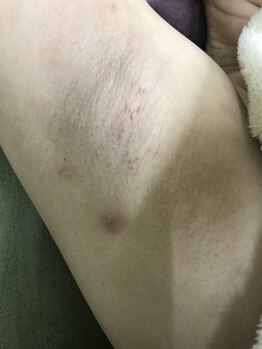 ナノハナ/鹿沼市全身脱毛ナノハナ