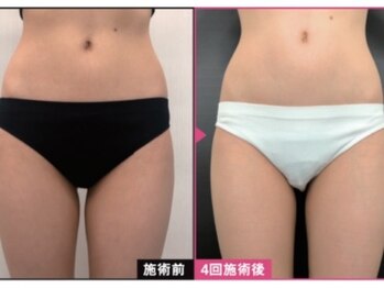 ホアロハ(Hoaloha)/ビーストロング～ビフォアフ～