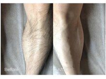 ルーナ(Luna)/メンズ　膝下脱毛