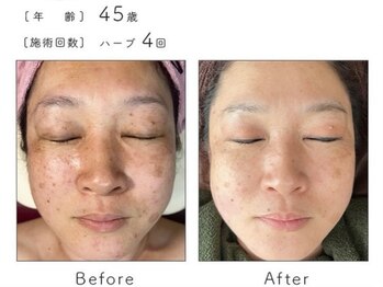 チップ(chip)/45歳/施術4回