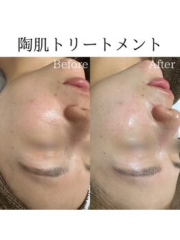 ビューティービューティー(BEAUTY BEAUTY)/陶肌トリートメント
