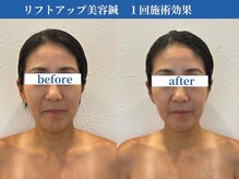 ラ カルナベル(La Carnabel)/美容鍼/耳つぼジュエリー/小顔