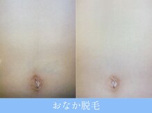 オーシャンブルー 大分店(OCEAN BLUE)/お腹脱毛