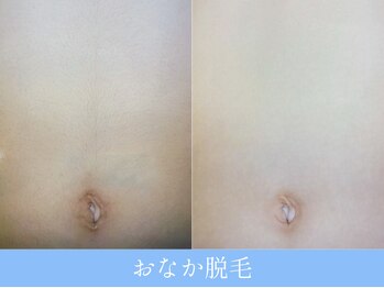 オーシャンブルー 大分店(OCEAN BLUE)/お腹脱毛