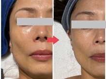 bou 新宿/ウィンバック４リフトアップ