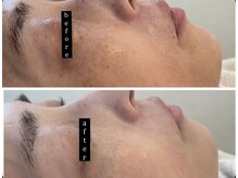 クロア ナゴヤ(Croire NAGOYA)/ビフォーアフター/光フォト