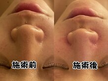 ルミエール 新宿(Lumierre)/ハーブピーリング＋毛穴洗浄