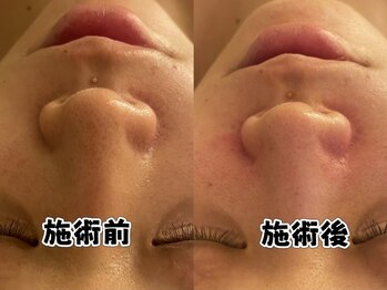 ルミエール 新宿(Lumierre)/ハーブピーリング+毛穴洗浄