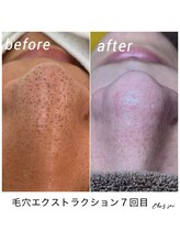 シェソワ(Chez soi)/毛穴エクストラクションJP認定