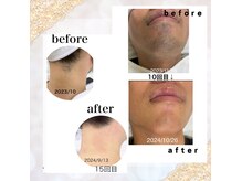 通いやすい【都度払い脱毛】男性は女性と一緒にご来店下さい。