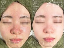 ベル 原宿(Belle)/ハーブピーリング｜ニキビケア