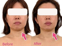 二重あご・たるみケアでキュッと引き締め♪理想の小顔に◎