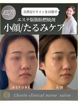 シェリー(Cherie)/30代フェイスラインのVライン