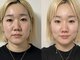 ティアラ(TIARA)の写真/理想の小顔へ！テラボーラーでたるみ改善しリフトアップとエイジングを叶える♪
