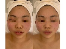 ナラビューティー(NARA BEAUTY)/コルギ1回効果