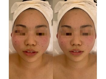 ナラビューティー(NARA BEAUTY)/コルギ1回効果