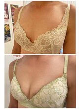美人バスト アンド ヒップアップ 広島店/バストアップ症例写真