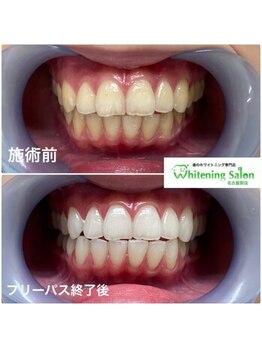 ホワイトニングサロン 名古屋駅店/【ホワイトニング施術例】