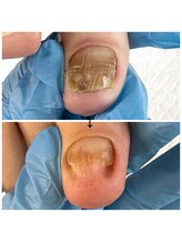 ネイルサロンアンドスクール ペルシャ(Persia)/剥離ケアは早めケアがオススメ