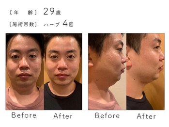 チップ(chip)/29歳/施術4回