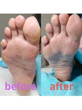 ドクターネイル爪革命 長野店/【たこ・うおのめ】リラク/足裏