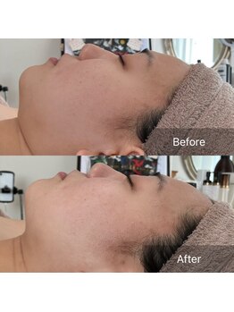 アイ(I)/顎下スッキリ小顔