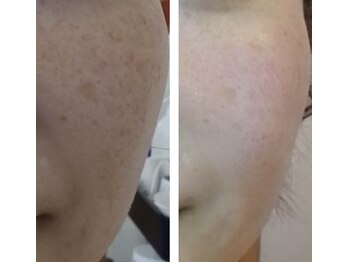 りた/たるみケア＆肌質改善が同時に叶