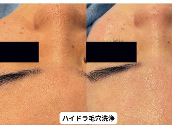 リメイク 銀座(REMAKE)/ハイドラ毛穴洗浄