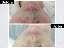 ポーベルポー(Peau Belle poe)/韓国美肌ララピール｜赤み・シミ