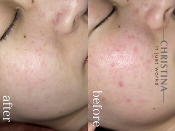 イデアル(Ideal)/赤ニキビにビオフィート¥9900～