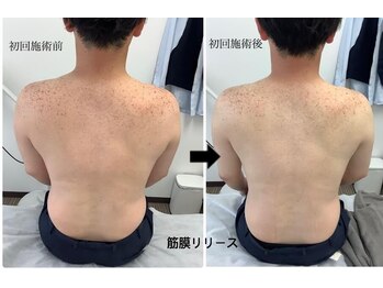 メディカルサロンドオフ 堺東店(medical salon de off)/筋膜リリース♪ビフォーアフター