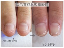 ドゥエ(doue')/深爪育成お客様経過写真