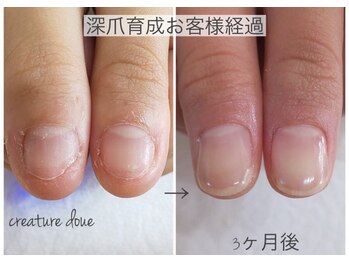 深爪育成お客様経過写真