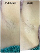 サロンドール(SalonDoll)/ハーブピーリング