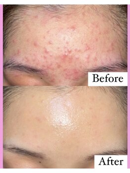 フェミニー(Feminy)/ニキビケア/黒ずみ改善