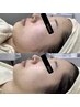 【小顔/毛穴/肌質改善】ハイドラ洗浄&小顔リフトUP＆乳歯幹細胞100％導入