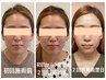 【二重アゴ】老け見えの原因、太いアゴ周りをスッキリさせたい方は、コチラ！