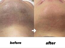 アース 津田沼店(EARTH Eye & Aesthetic)/【メンズヒゲ脱毛】12回