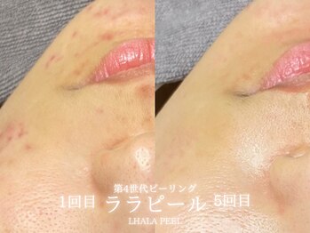 リル 和歌山市店(lilou)/ララピールBefore After！