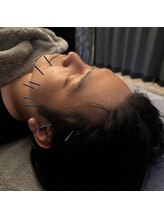 アロエベル(aloe Belle)/美容鍼