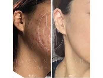 多穏スキンケア(skin care)/ニキビケア