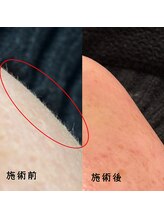 フルールスレーヌ(Fleur Sereine)/シュガーリング+光脱毛