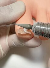 牛久巻き爪センター/5. 補正具の整え