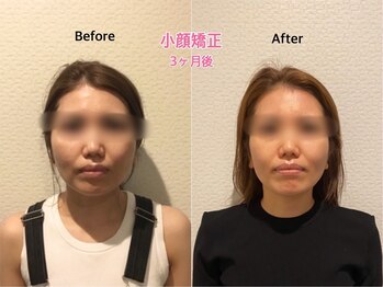 チキバン美容鍼灸整体サロン 心斎橋店/ 小顔矯正