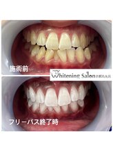 ホワイトニングサロン 京都烏丸店/ホワイトニング　施術例