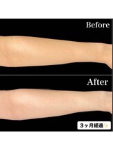 リブ(Lib)/夏に向けて全身美白美肌ケア♪